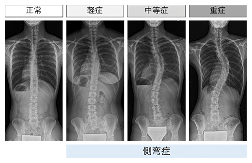 思春期特発性側弯症のX線写真の図