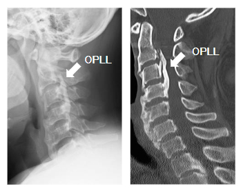 脊柱後縦靭帯骨化症（OPLL）の画像所見の2つの図