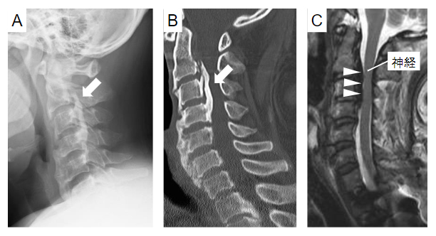 脊柱後縦靭帯骨化症（OPLL）の画像所見の3つの図