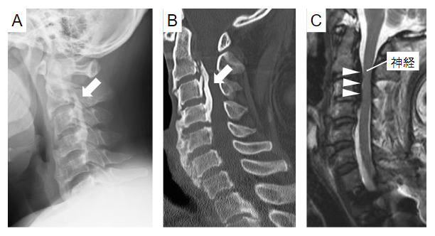 脊柱後縦靭帯骨化症(OPLL)の画像所見の3つの図