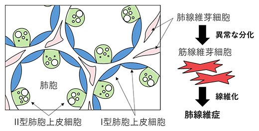 肺胞と肺線維化の図