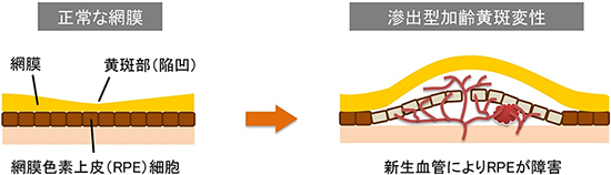 正常な網膜と滲出型加齢黄斑変性との比較図