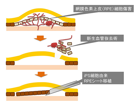 iPS細胞由来網膜色素上皮（RPE）シートの移植説明図