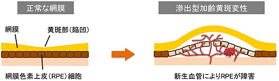 正常な網膜から滲出型加齢黄斑変性との比較図