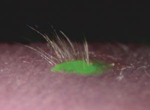 Image of transplanted skin
