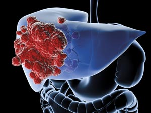 Image of liver tumors Image of liver tumors