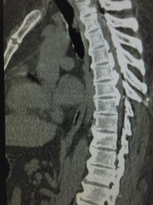 Image of bones with spinal disorder