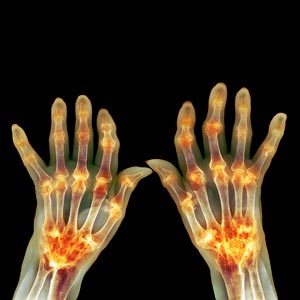 Image of rheumatoid arthritis