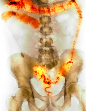 Image of the inflamed and ulcerated colon