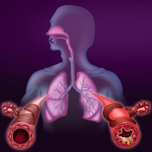 Image of lungs affected by asthma