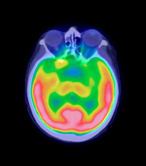 Image obtained by PET imaging
