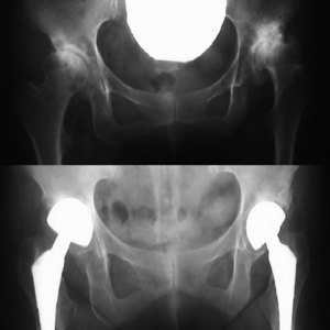 X-ray image of diseased hips