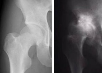 X-ray image of hip joint