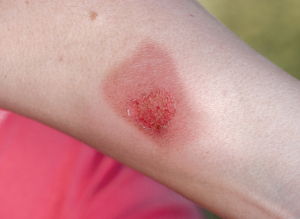 Image of a steam burn to the forearm