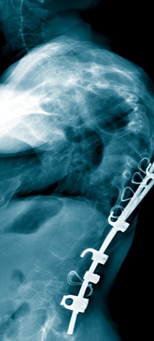 Image of spinal x-ray
