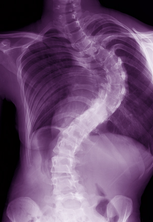 X-ray image of a child with AIS