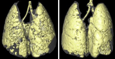 Image of lungs
