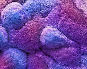 Microscopic image of breast cancer cells