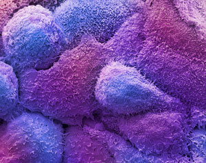 image of breast cancer cells