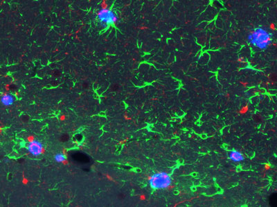 image of hallmark signs of Alzheimer's disease in the brain