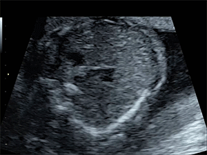 Ultrasound image of abnormal heart