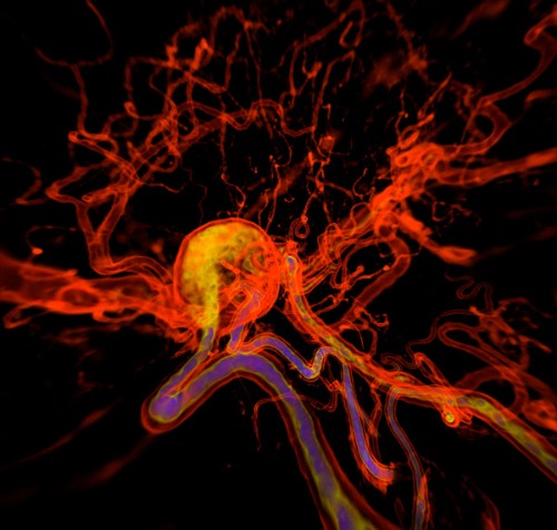 image of an intracranial aneurysm
