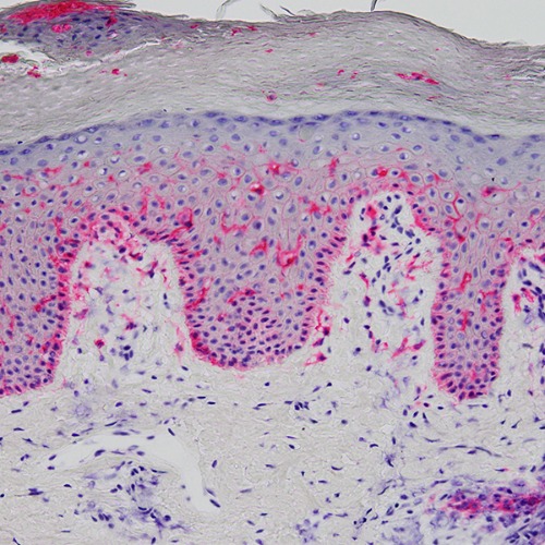 image of the skin from a patient with atopic dermatitis