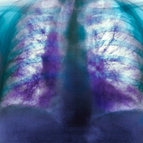 image of x-ray of the chest